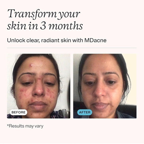 MDacne Customized Treatment Cream .5oz - Picture 4 of 5